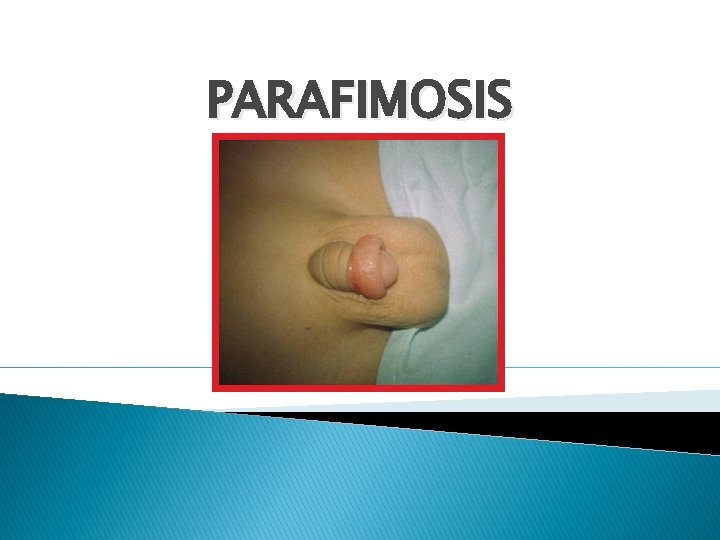 PARAFIMOSIS PARAFIMOSIS