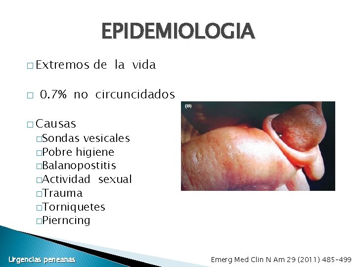 EPIDEMIOLOGIA � Extremos � de la vida 0. 7% no circuncidados � Causas �Sondas EPIDEMIOLOGIA � Extremos � de la vida 0. 7% no circuncidados � Causas �Sondas