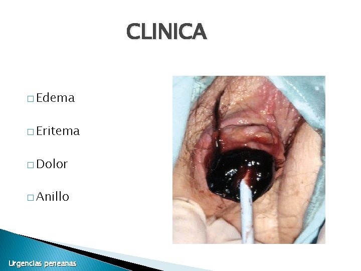 CLINICA � Edema � Eritema � Dolor � Anillo Urgencias peneanas CLINICA � Edema � Eritema � Dolor � Anillo Urgencias peneanas