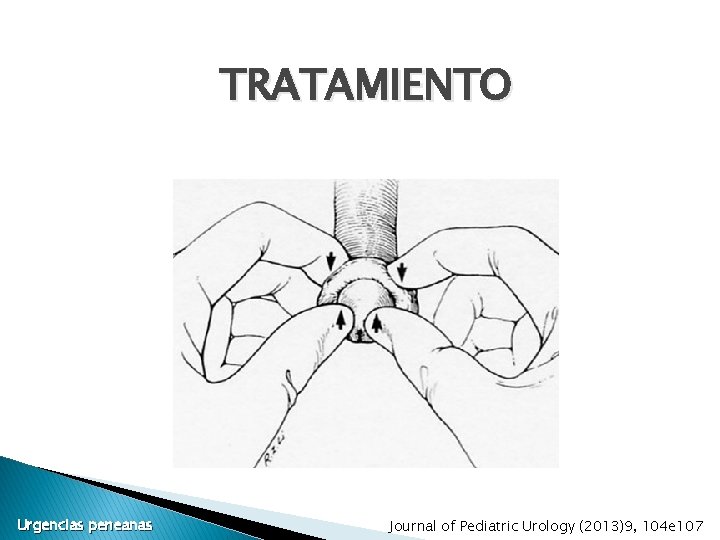 TRATAMIENTO Urgencias peneanas Journal of Pediatric Urology (2013)9, 104 e 107 TRATAMIENTO Urgencias peneanas Journal of Pediatric Urology (2013)9, 104 e 107