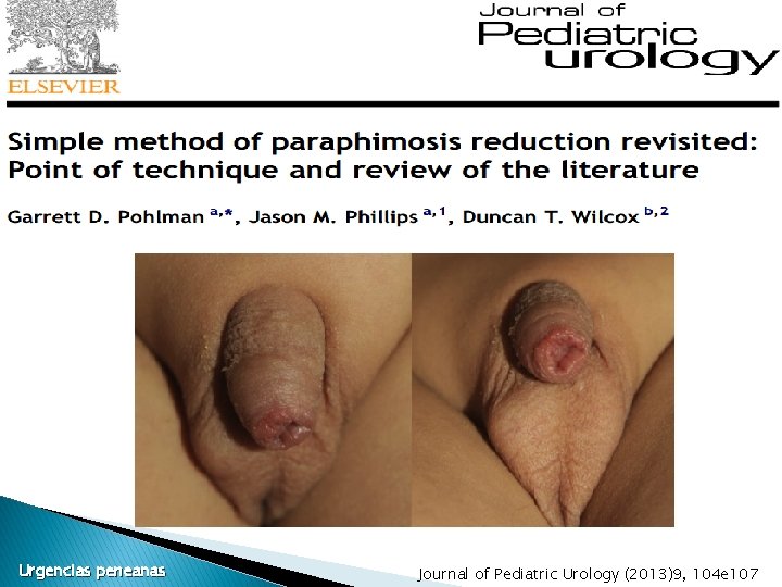 Urgencias peneanas Journal of Pediatric Urology (2013)9, 104 e 107 Urgencias peneanas Journal of Pediatric Urology (2013)9, 104 e 107
