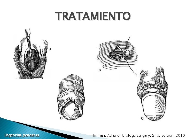 TRATAMIENTO Urgencias peneanas Hinman, Atlas of Urology Surgery, 2 nd, Edition, 2010 TRATAMIENTO Urgencias peneanas Hinman, Atlas of Urology Surgery, 2 nd, Edition, 2010