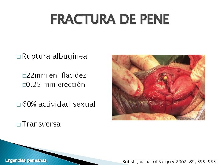 FRACTURA DE PENE � Ruptura albugínea � 22 mm en flacidez � 0. 25 FRACTURA DE PENE � Ruptura albugínea � 22 mm en flacidez � 0. 25
