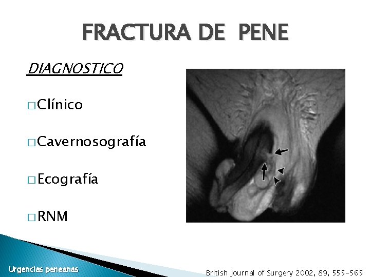 FRACTURA DE PENE DIAGNOSTICO � Clínico � Cavernosografía � Ecografía � RNM Urgencias peneanas FRACTURA DE PENE DIAGNOSTICO � Clínico � Cavernosografía � Ecografía � RNM Urgencias peneanas