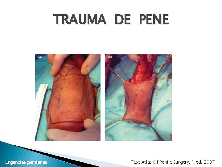 TRAUMA DE PENE Urgencias peneanas Text Atlas Of Penile Surgery, 1 ed, 2007 TRAUMA DE PENE Urgencias peneanas Text Atlas Of Penile Surgery, 1 ed, 2007
