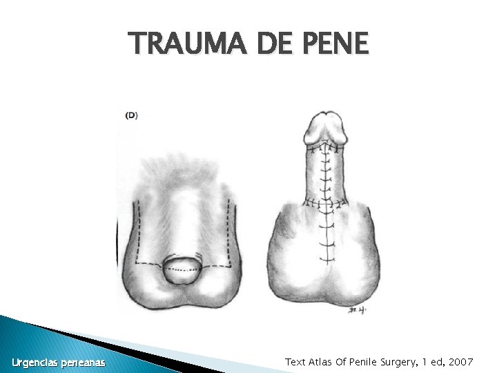 TRAUMA DE PENE Urgencias peneanas Text Atlas Of Penile Surgery, 1 ed, 2007 TRAUMA DE PENE Urgencias peneanas Text Atlas Of Penile Surgery, 1 ed, 2007