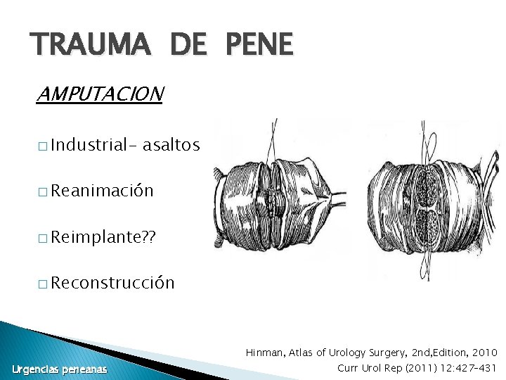 TRAUMA DE PENE AMPUTACION � Industrial- asaltos � Reanimación � Reimplante? ? � Reconstrucción TRAUMA DE PENE AMPUTACION � Industrial- asaltos � Reanimación � Reimplante? ? � Reconstrucción