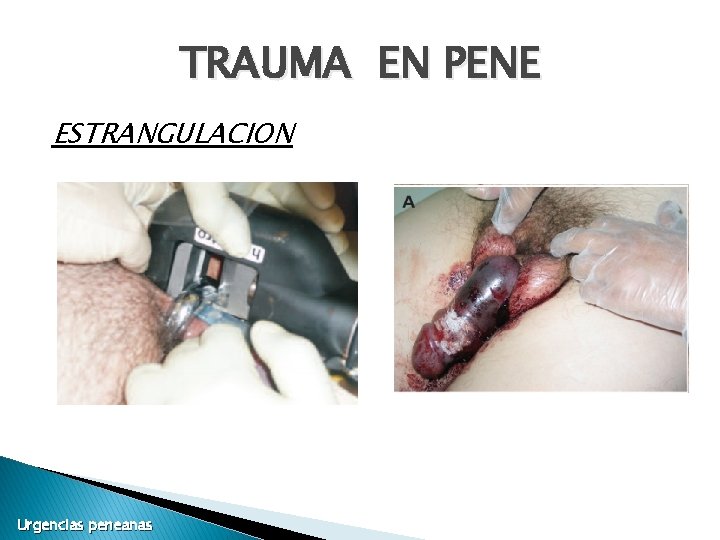 TRAUMA EN PENE ESTRANGULACION Urgencias peneanas TRAUMA EN PENE ESTRANGULACION Urgencias peneanas