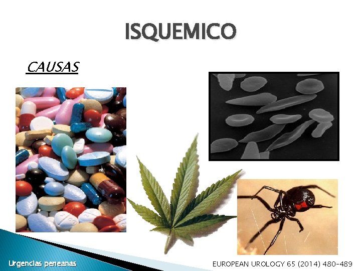 ISQUEMICO CAUSAS Urgencias peneanas EUROPEAN UROLOGY 65 (2014) 480– 489 ISQUEMICO CAUSAS Urgencias peneanas EUROPEAN UROLOGY 65 (2014) 480– 489