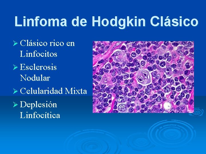 Linfoma de Hodgkin Clásico Ø Clásico rico en Linfocitos Ø Esclerosis Nodular Ø Celularidad