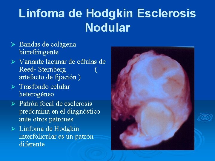 Linfoma de Hodgkin Esclerosis Nodular Ø Ø Ø Bandas de colágena birrefringente Variante lacunar