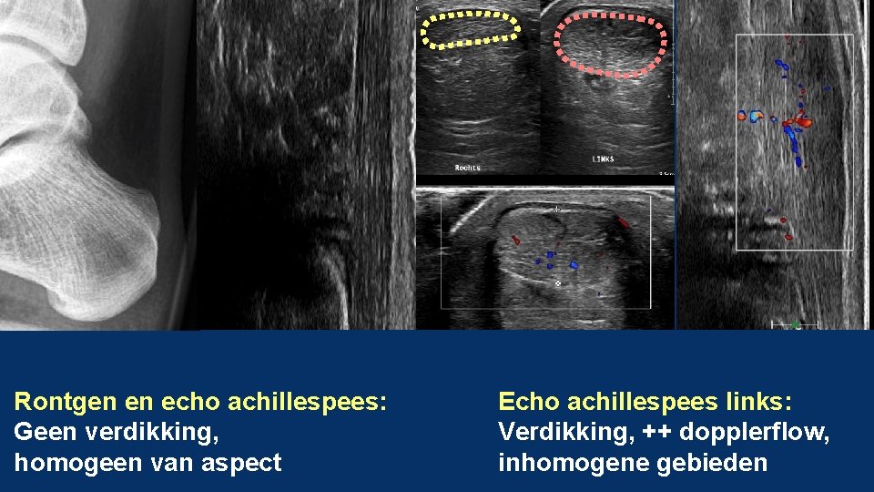 Rontgen en echo achillespees: Geen verdikking, homogeen van aspect Echo achillespees links: Verdikking, ++