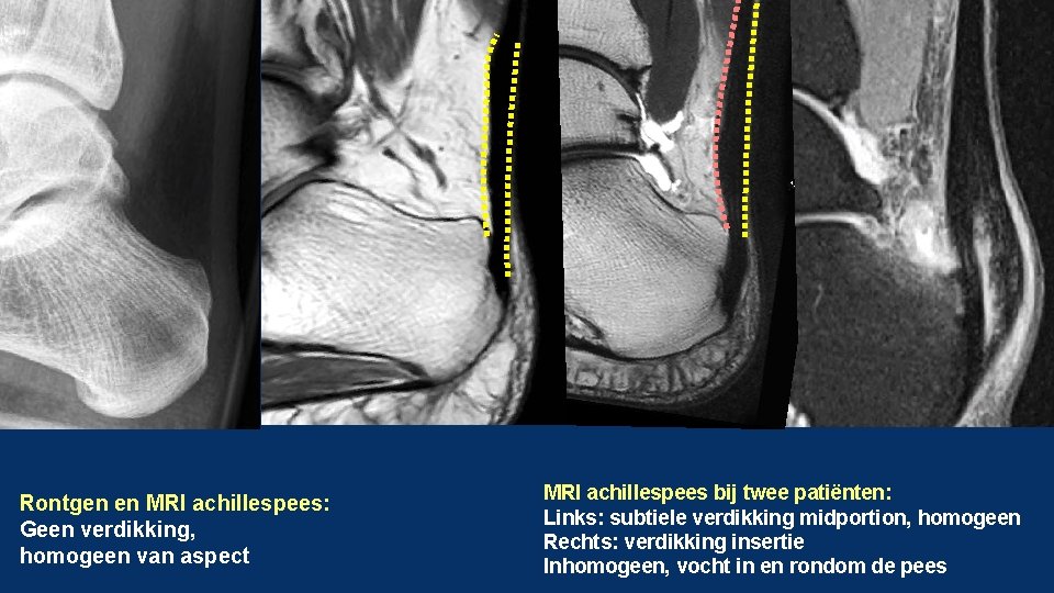 Rontgen en MRI achillespees: Geen verdikking, homogeen van aspect MRI achillespees bij twee patiënten: