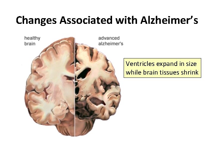 Changes Associated with Alzheimer’s Ventricles expand in size while brain tissues shrink 
