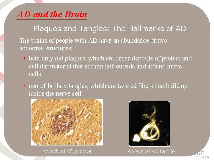AD and the Brain Plaques and Tangles: The Hallmarks of AD The brains of