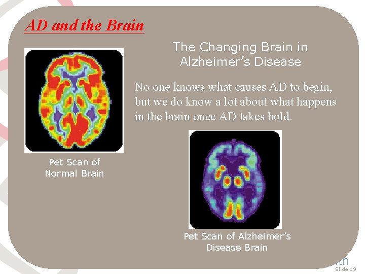 AD and the Brain The Changing Brain in Alzheimer’s Disease No one knows what