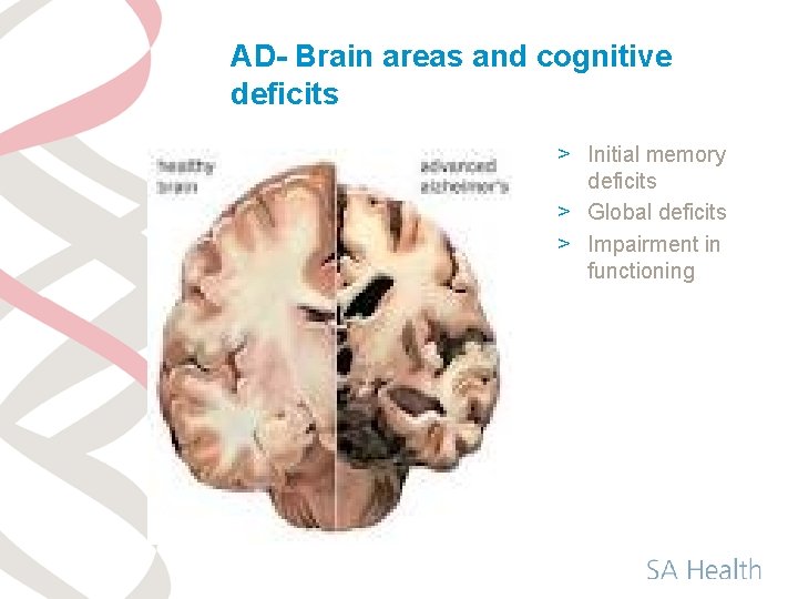 AD- Brain areas and cognitive deficits > Initial memory deficits > Global deficits >