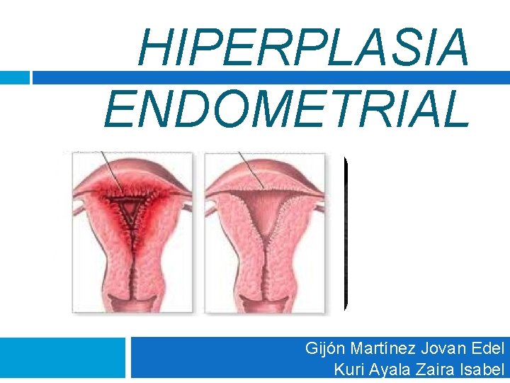 HIPERPLASIA ENDOMETRIAL Gijón Martínez Jovan Edel Kuri Ayala Zaira Isabel HIPERPLASIA ENDOMETRIAL Gijón Martínez Jovan Edel Kuri Ayala Zaira Isabel