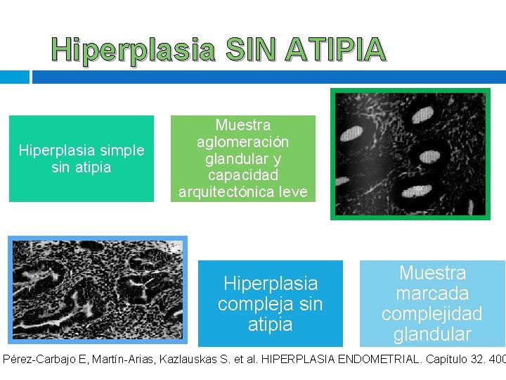 Hiperplasia SIN ATIPIA Hiperplasia simple sin atipia Muestra aglomeración glandular y capacidad arquitectónica leve Hiperplasia SIN ATIPIA Hiperplasia simple sin atipia Muestra aglomeración glandular y capacidad arquitectónica leve