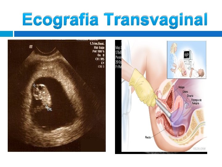 Ecografia Transvaginal Ecografia Transvaginal