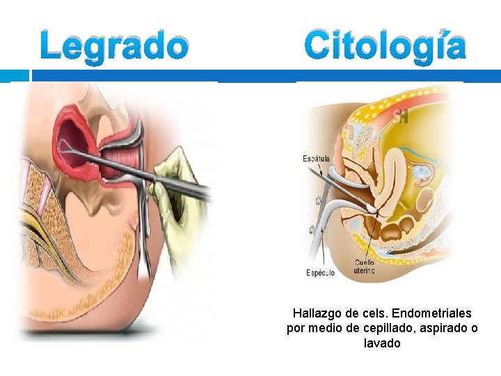 Legrado Citología Hallazgo de cels. Endometriales por medio de cepillado, aspirado o lavado Legrado Citología Hallazgo de cels. Endometriales por medio de cepillado, aspirado o lavado