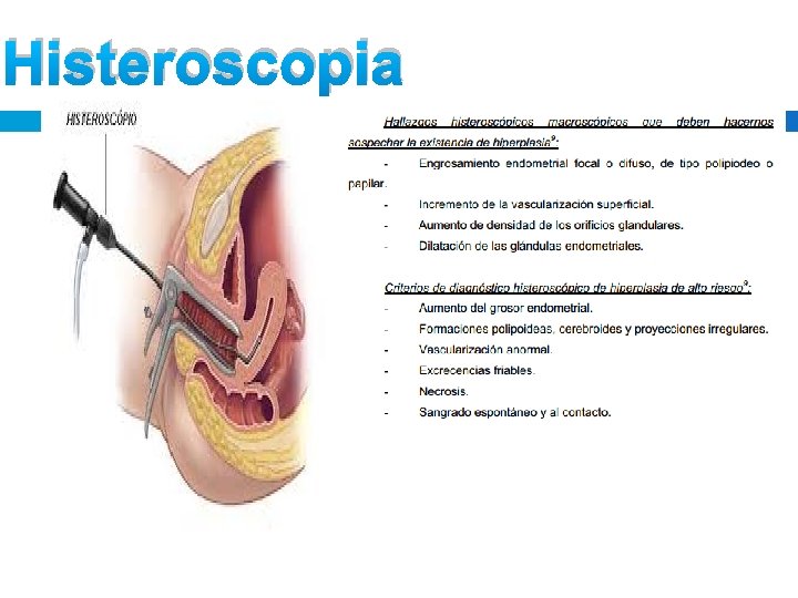 Histeroscopia Histeroscopia