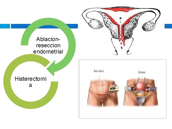 Ablacionreseccion endometrial Histerectomí a Ablacionreseccion endometrial Histerectomí a