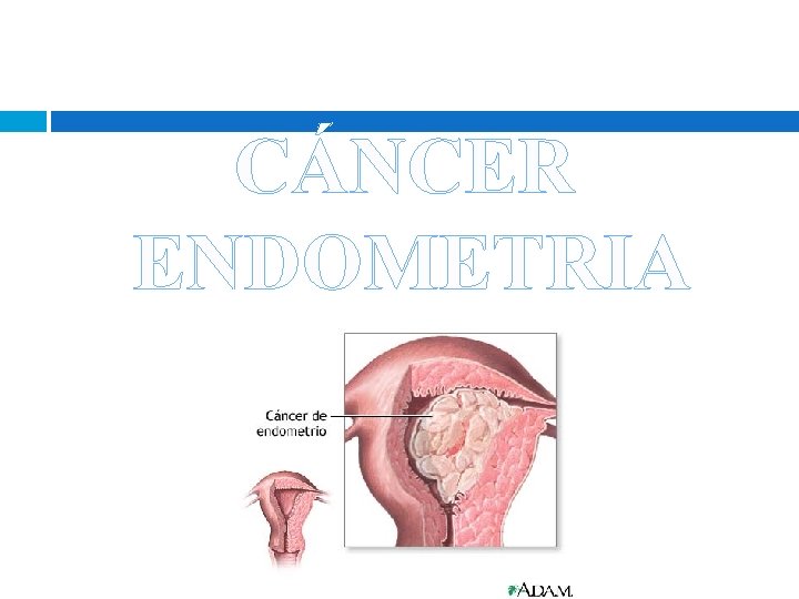 CÁNCER ENDOMETRIA L CÁNCER ENDOMETRIA L