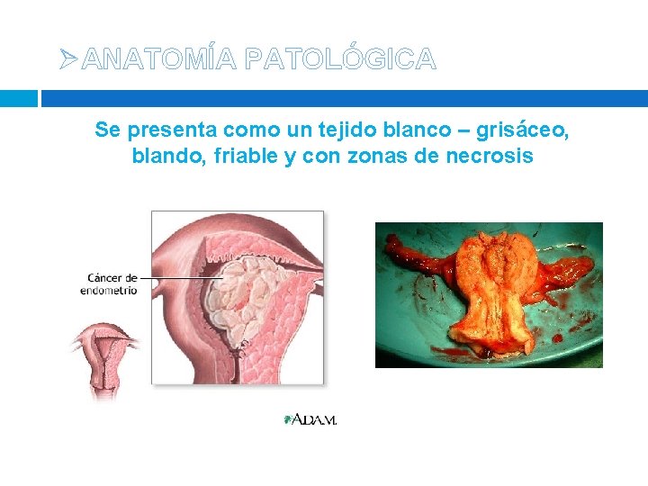 ØANATOMÍA PATOLÓGICA Se presenta como un tejido blanco – grisáceo, blando, friable y con ØANATOMÍA PATOLÓGICA Se presenta como un tejido blanco – grisáceo, blando, friable y con