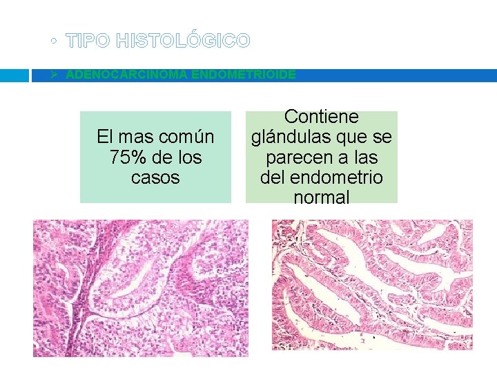 • TIPO HISTOLÓGICO Ø ADENOCARCINOMA ENDOMETRIOIDE El mas común 75% de los casos • TIPO HISTOLÓGICO Ø ADENOCARCINOMA ENDOMETRIOIDE El mas común 75% de los casos