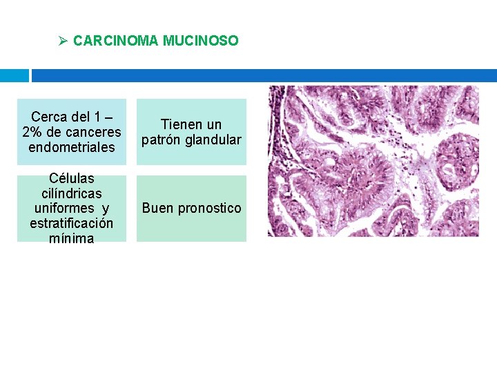 Ø CARCINOMA MUCINOSO Cerca del 1 – 2% de canceres endometriales Tienen un patrón Ø CARCINOMA MUCINOSO Cerca del 1 – 2% de canceres endometriales Tienen un patrón