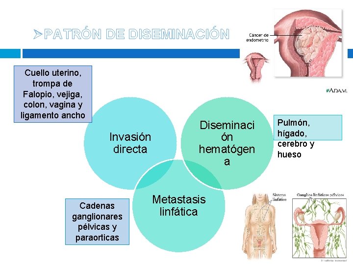 ØPATRÓN DE DISEMINACIÓN Cuello uterino, trompa de Falopio, vejiga, colon, vagina y ligamento ancho ØPATRÓN DE DISEMINACIÓN Cuello uterino, trompa de Falopio, vejiga, colon, vagina y ligamento ancho