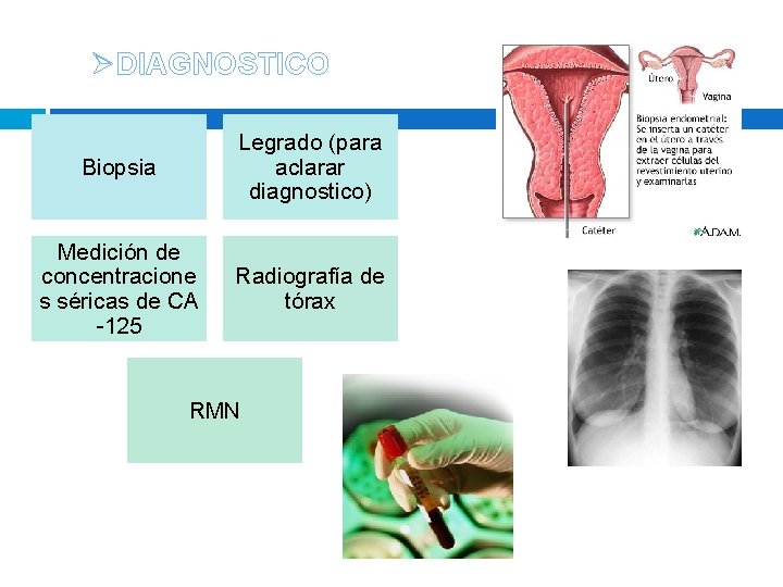 ØDIAGNOSTICO Biopsia Legrado (para aclarar diagnostico) Medición de concentracione s séricas de CA -125 ØDIAGNOSTICO Biopsia Legrado (para aclarar diagnostico) Medición de concentracione s séricas de CA -125