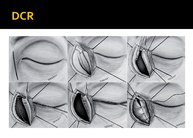 DCR 