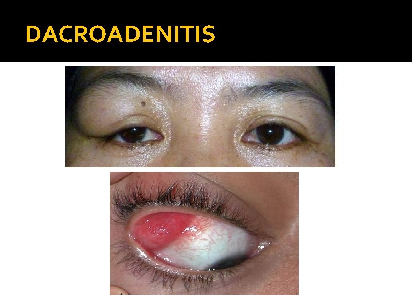 DACROADENITIS 