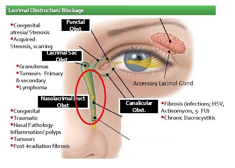 Lacrimal Obstruction/ Blockage Congenital- Punctal Obst atresia/ Stenosis Acquired. Stenosis, scarring Lacrimal Sac Obst