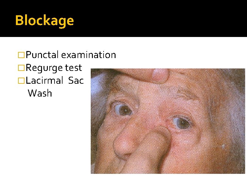 Blockage �Punctal examination �Regurge test �Lacirmal Sac Wash 