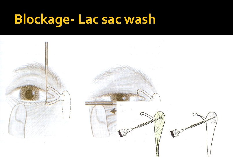 Blockage- Lac sac wash 