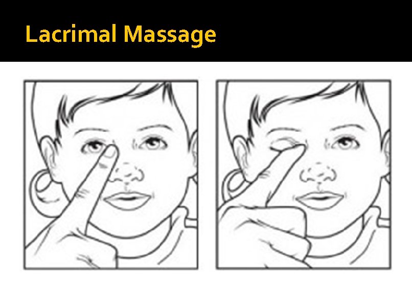 Lacrimal Massage 