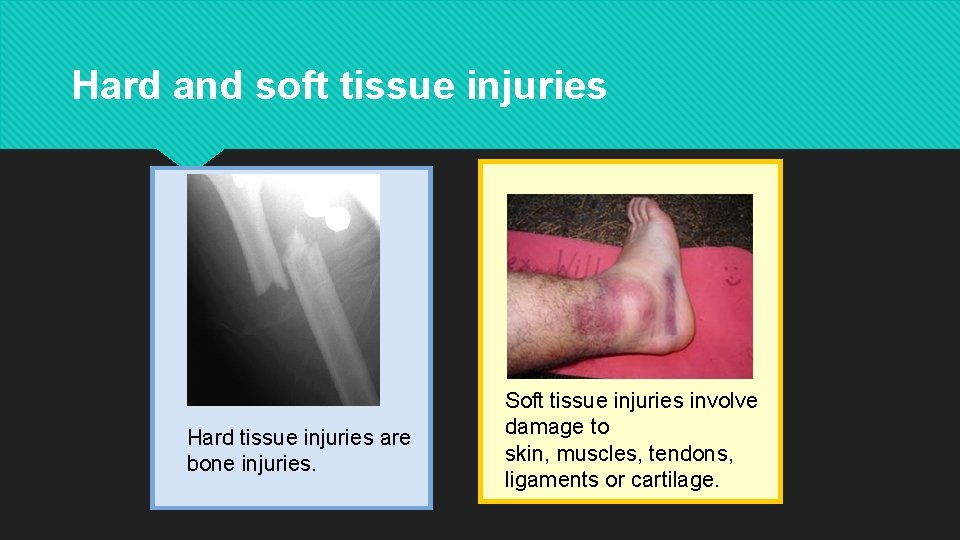 Hard and soft tissue injuries Hard tissue injuries are bone injuries. Soft tissue injuries