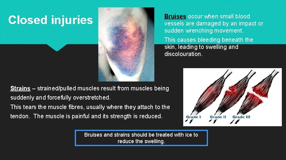 Closed injuries Bruises occur when small blood vessels are damaged by an impact or