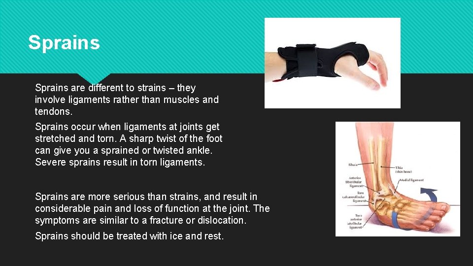 Sprains are different to strains – they involve ligaments rather than muscles and tendons.