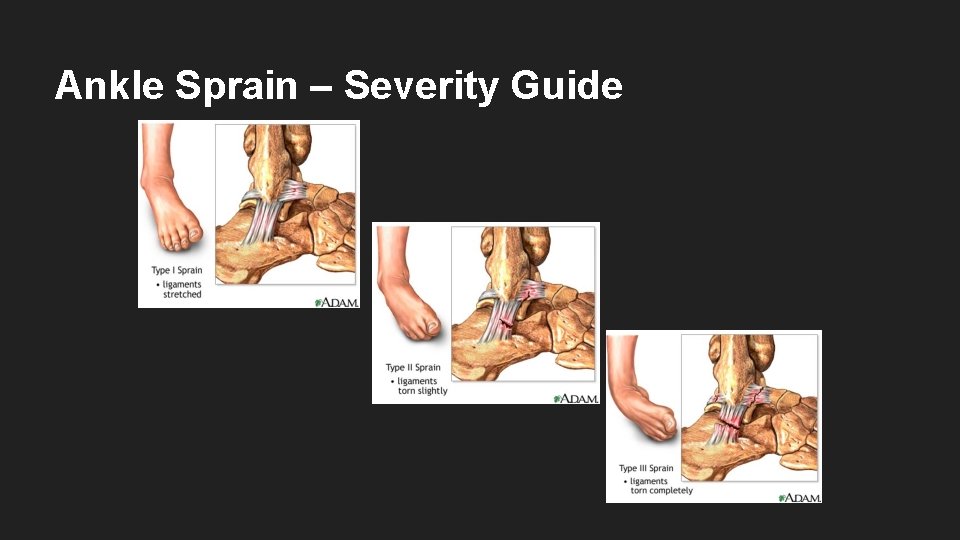 Ankle Sprain – Severity Guide 