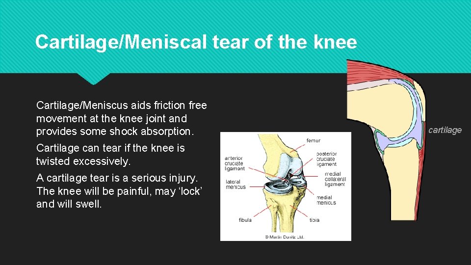 Cartilage/Meniscal tear of the knee Cartilage/Meniscus aids friction free movement at the knee joint