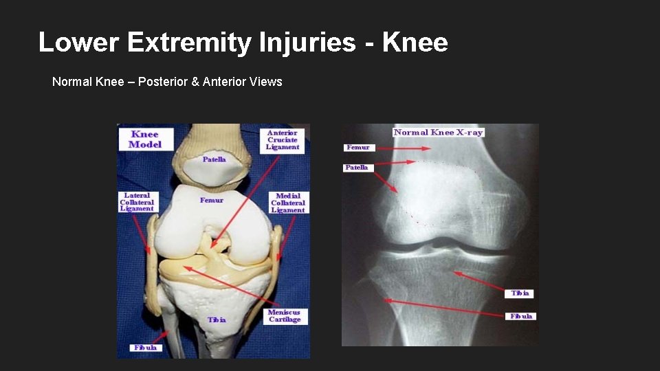 Lower Extremity Injuries - Knee Normal Knee – Posterior & Anterior Views 