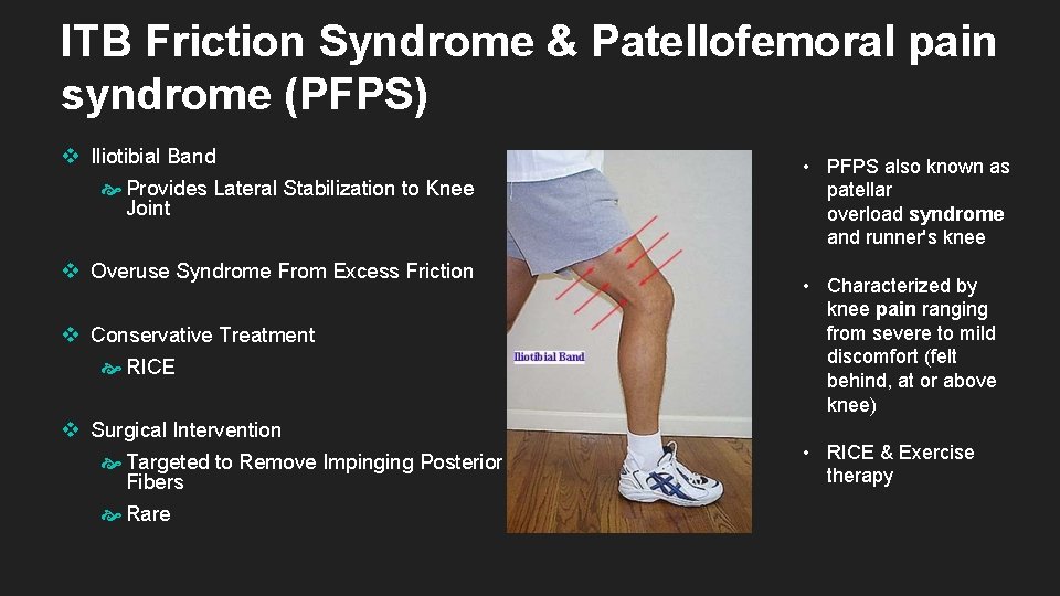 ITB Friction Syndrome & Patellofemoral pain syndrome (PFPS) v Iliotibial Band Provides Lateral Stabilization