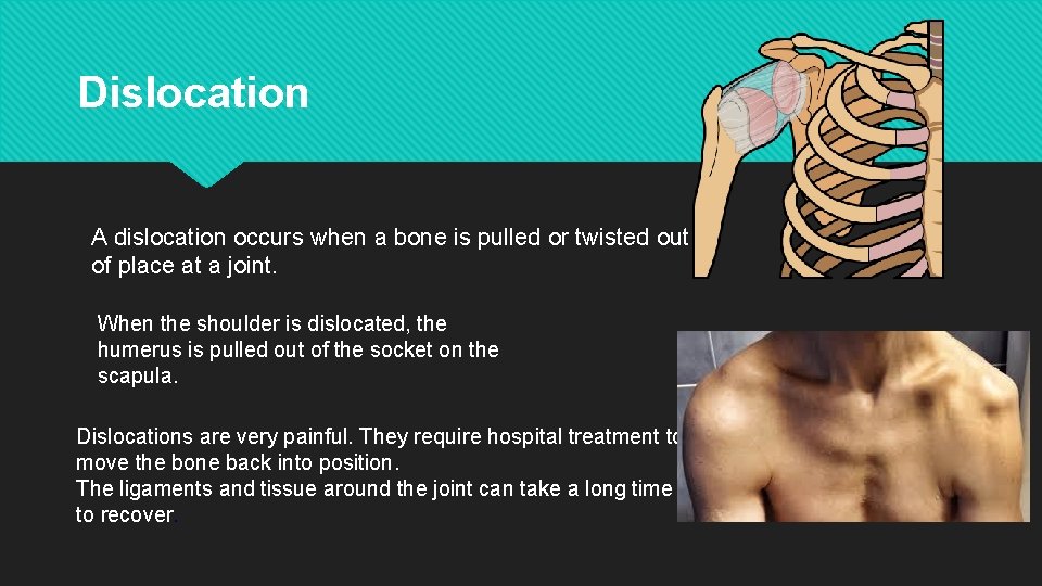 Dislocation A dislocation occurs when a bone is pulled or twisted out of place