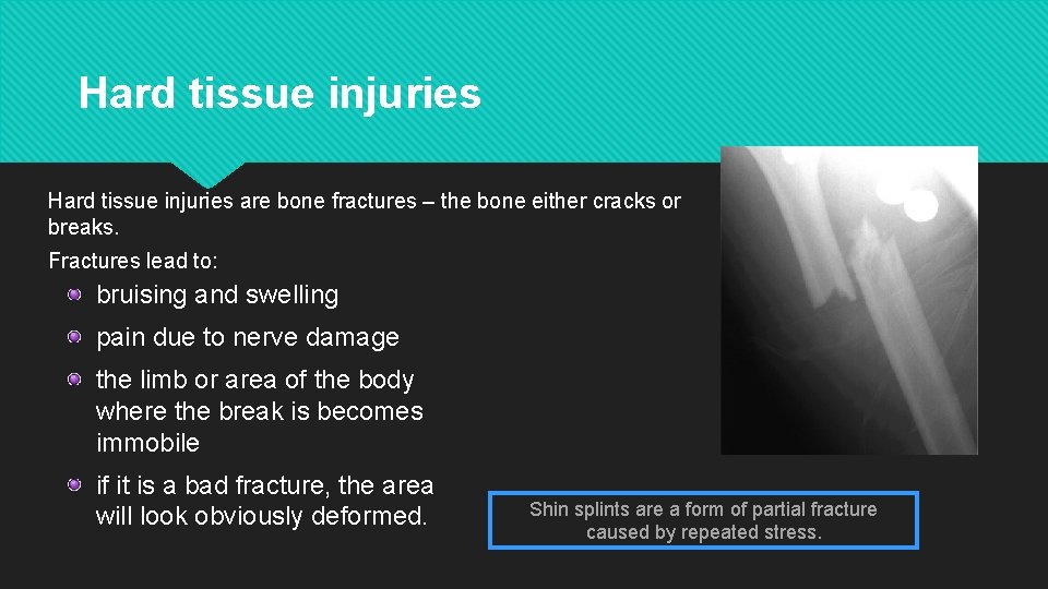 Hard tissue injuries are bone fractures – the bone either cracks or breaks. Fractures