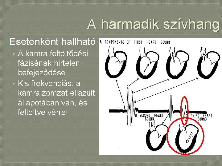 A harmadik szívhang �Esetenként hallható • A kamra feltöltődési fázisának hirtelen befejeződése • Kis