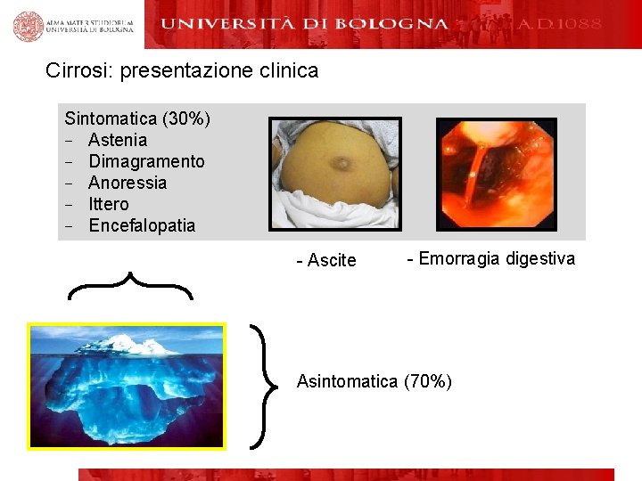 Cirrosi: presentazione clinica Sintomatica (30%) − Astenia − Dimagramento − Anoressia − Ittero −